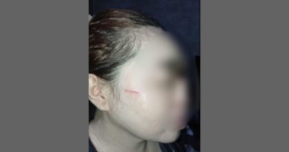 Korban dugaan penganiayaan oleh istri oknum polisi di Butur. Dok: Istimewa.